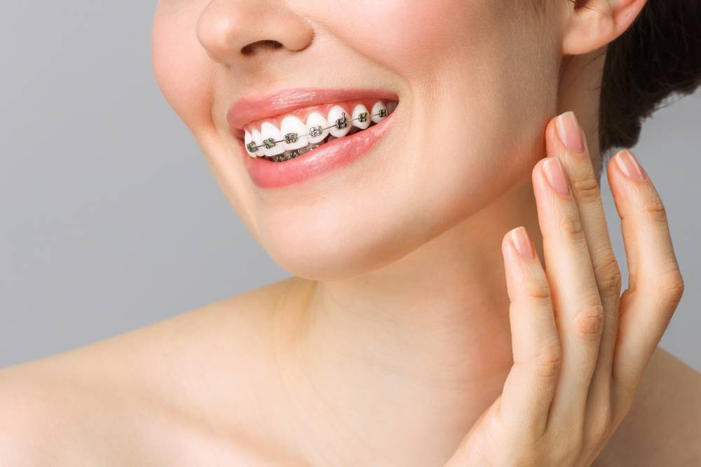 Cómo cuidar tu higiene dental si llevas ortodoncia fija