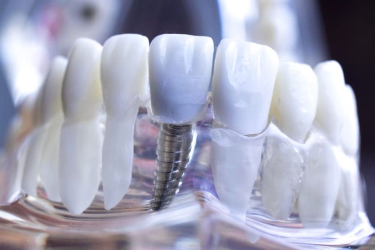 Implantes dentales de nueva generación